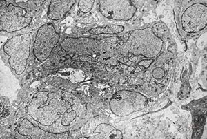 M,3y. | plexus papilloma M,3y. | plexus papilloma